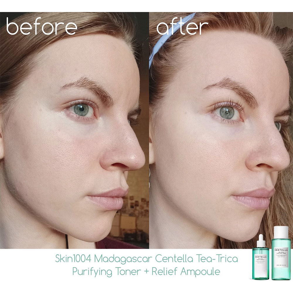 تونر ضد جوش تی تریکا اسکین 1004 (SKIN1004 Centella Tea-Trica Purifying Toner) - تصویر 4